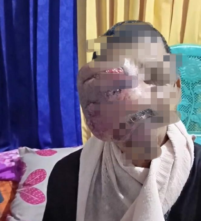 
 Terkendala Biaya, Setahun Sudah Jahudin Tahan Rasa Sakit Tumor Di Wajahnya